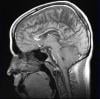 Functional MRI May Help Identify More Effective Painkillers for Chronic Pain Sufferers