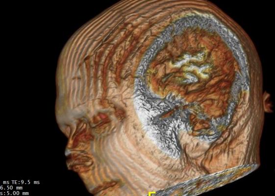 MRI, blood brain barrier, BBB, Alzheimer's, Radiology journal