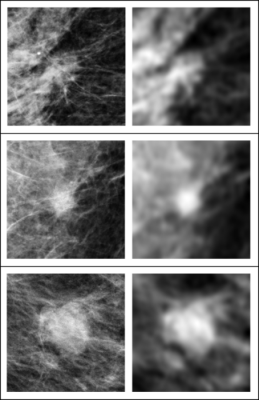 In these three examples of soft tissue lesions, the images are unperturbed on the left column and blurred on the right column. The AI system was sensitive to the blurring, while the radiologists were not. This showed that the AI system relies on details in soft tissue lesions that are considered irrelevant by the radiologists. Image courtesy of Taro Makino, NYU’s Center for Data Science
