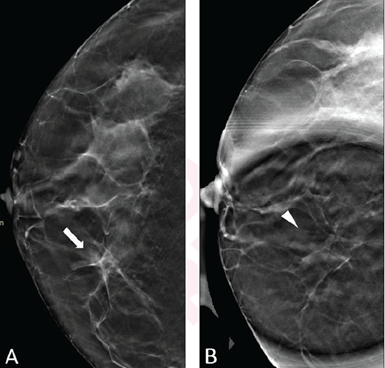 52-Year-Old Woman Presenting for Asymmetry of Right Breast: (A) DBT craniocaudal view shows asymmetry (arrow) in medial right breast (DBT). (B) DBT spot compression view shows asymmetry does not persist (arrowhead). Lesion classified on DBT without, and DBT with, DBT spot compression view as BI-RADS category 4a and 2 by reader 1, category 4a and 2 by reader 2, and category 4b and 2 by reader 3. Follow-up imaging at one year demonstrated stability of finding, consistent with benignity in present analysis.