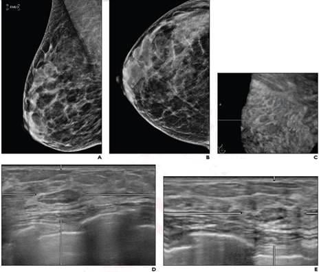 According to ARRS’ American Journal of Roentgenology (AJR), return to routine screening for BI-RADS 3 lesions on supplemental automated whole-breast US (ABUS) substantially reduces the recall rate, while being unlikely to result in adverse outcome