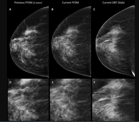 Breast Tomosynthesis Increases Cancer Detection Over Digital Mammography