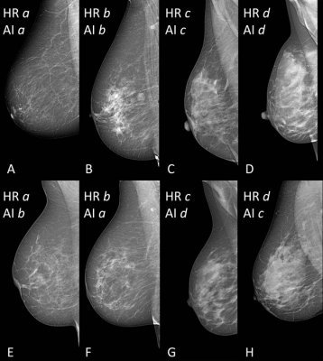 Selection of mammographic mediolateral oblique views of breasts with different breast density from women between 51 and 68 years of age. 