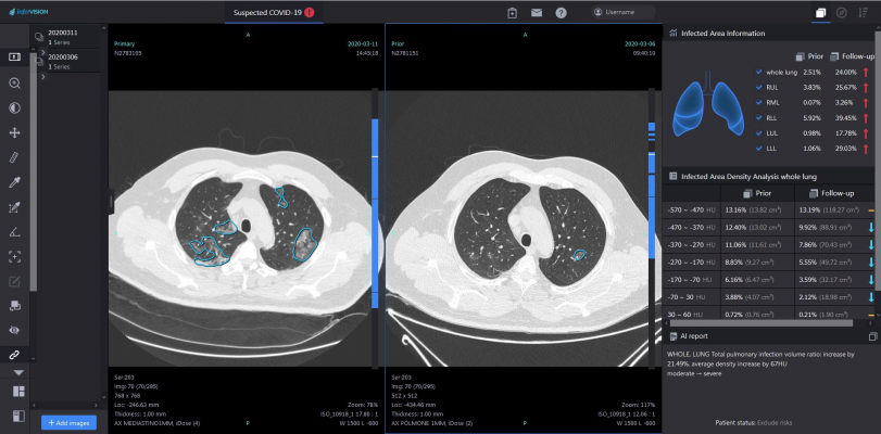 #COVID19 #Coronavirus #2019nCoV #Wuhanvirus #SARScov2 The Chinese start-up company Infervision launches its AI-based solution InferRead CT Lung Covid-19 also in Europe 