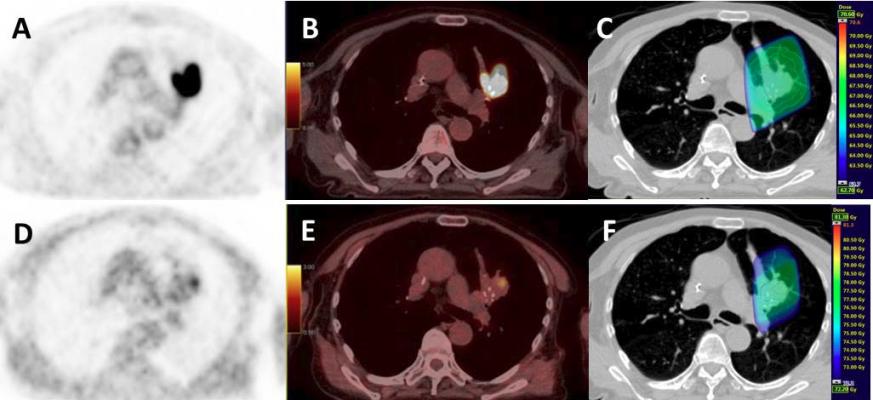 Age Impacts Post-treatment Mortality for Early-stage Lung Cancer Patients