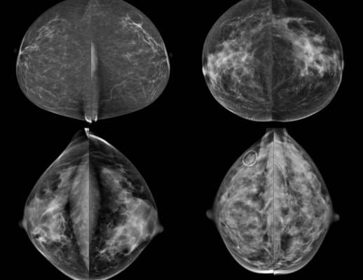 breast density, evaluation, BI-RADS, unreliable, UC Davis study