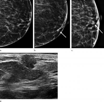 Images show symptomatic false-negative cancer in a 73-year-old black woman who presented with a palpable abnormality 64 days after negative screening mammography. (a) Negative screening left digital breast tomosynthesis (DBT) mammogram. (b) Diagnostic DBT mammogram shows a new palpable mass (arrow). (c) Spot-compression DBT mammogram enables confirmation of mass (arrow). (d) Ultrasound (US) image shows hypoechoic mass with angular margins. Subsequent US-guided biopsy revealed estrogen receptor- and progeste
