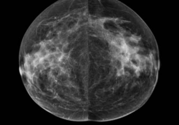 New Study Highlights Breakthrough Therapy to Reduce Mammographic Breast Density
