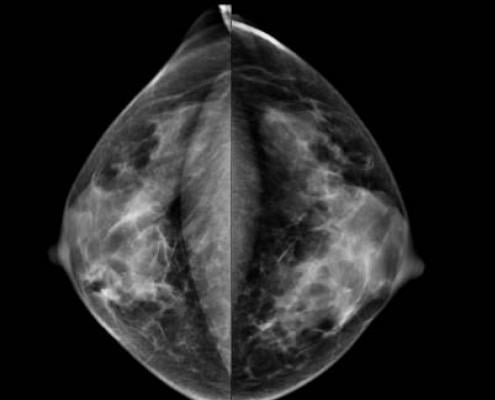 New Hampshire, breast density inform bill, January
