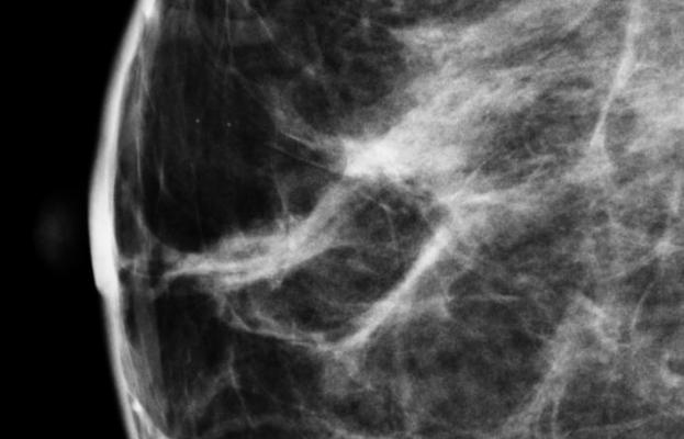 breast density, adolescents, dietary fat intake, breast cancer risk, study