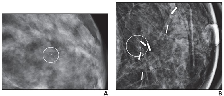 48-year-old woman with recurrent ductal carcinoma in situ (DCIS) in left breast