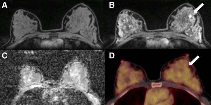 A 50-y-old postmenopausal woman with fibroadenoma (arrows) in left breast