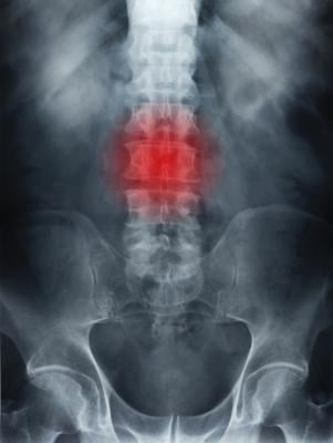 Researchers found that a minimally invasive procedure combined with epidural steroid injection treatment led to superior pain reduction and disability improvement over one year in patients with sciatica.