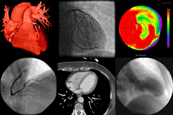 A new study published in Radiology: Cardiothoracic Imaging on cardiac imaging trends over a decade reports that the rate of coronary computed tomography angiography (cCTA) exams by radiologists in hospital outpatient departments increased markedly from 2010 to 2019, suggesting a bright future for the technology.