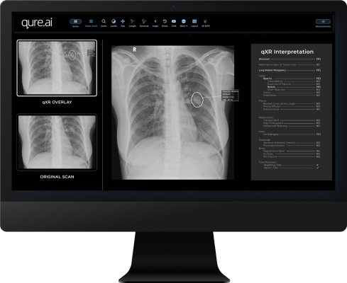 Qure.ai has announced that its AI-enabled Chest X-ray solution for Pneumothorax and Pleural Effusion has received 510(k) clearance from the U.S. Food and Drug Administration (FDA). 