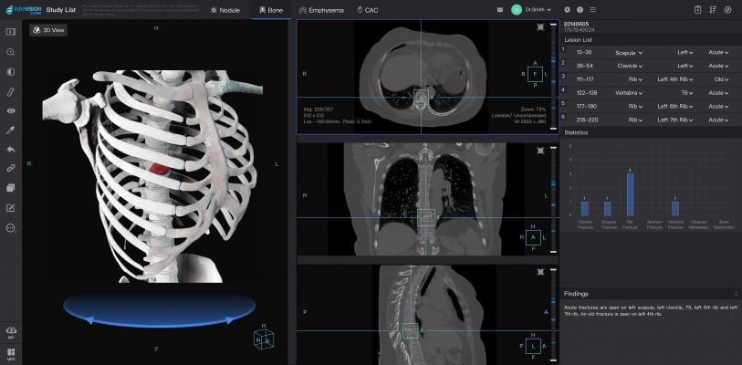 Infervision Introduces AI Capabilities for Chest CT Reading