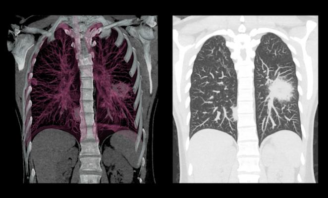 Matrix Analytics Beginning Validation of Deep Learning Lung CT Tools