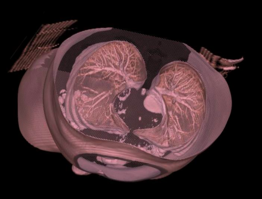 Automatic Deformable Alignment Significantly Reduces Radiologist Time to Match Lung Nodule Locations