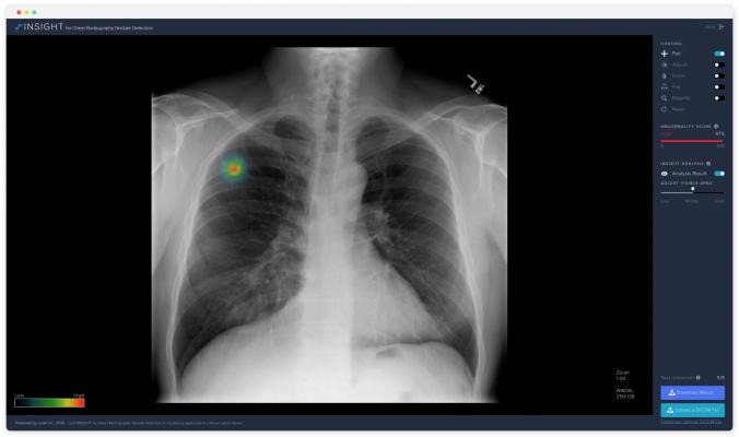 AI Biomarker Demonstrates High Predictive Power for Lung Cancer Immunotherapy