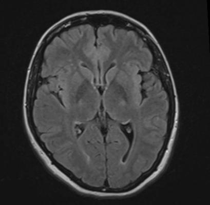 MRI, substance abuse, women, brain volume, Jody Tanabe, Colorado Denver