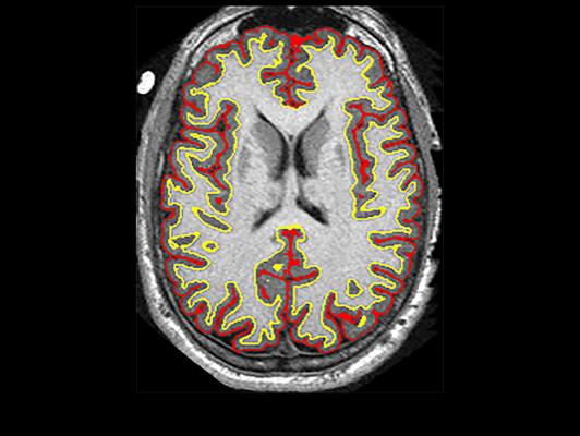 Study Finds Multiple Sclerosis Drug Slows Brain Shrinkage