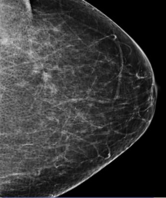 breast cancer screening, death risk, 40 percent, Queen Mary University of London