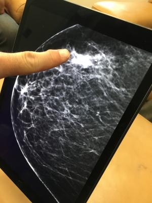 Breast Cancer Follow-up Imaging Varies Widely
