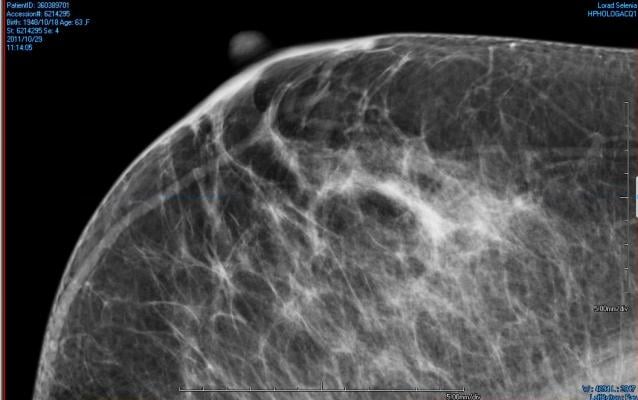 An example of areas of dense breast tissue (white areas) on a mammography X-ray.
