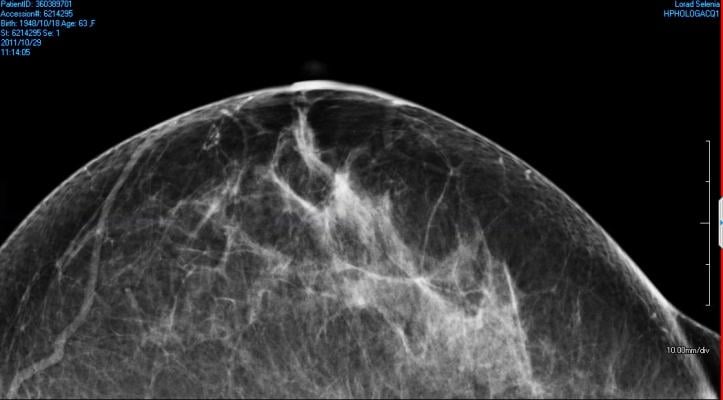UC Davis study, digital mammography, safety, radiation risk