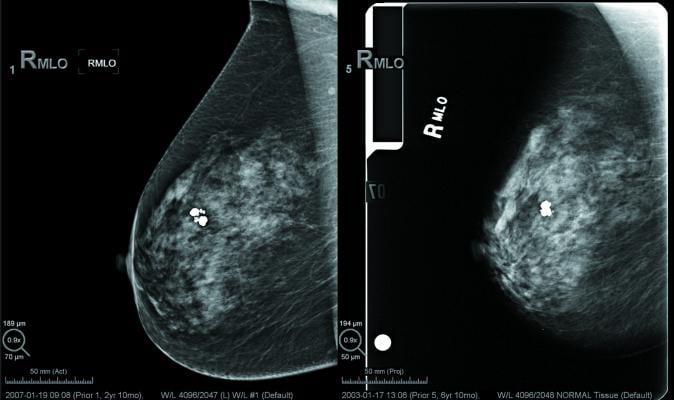 dense breast tissue, dense breast imaging, BIRADS, BI-RADS, mammography grading system, comparison of dense breast tissue, Fibroglandular densities