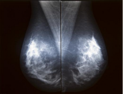 FDA, alternative standard, full field digital mammography, FFDM, qualtity assurance QA