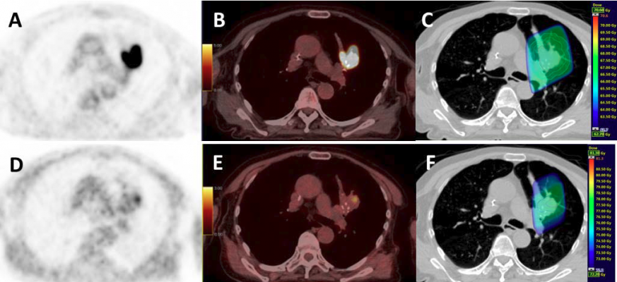 PET/CT Tracer Identifies Vulnerable Lesions in Non-Small Cell Lung Cancer Patients