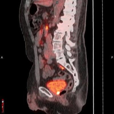 POSLUMA is indicated for positron emission tomography (PET) of prostate-specific membrane antigen (PSMA) positive lesions in men with prostate cancer with suspected metastasis 