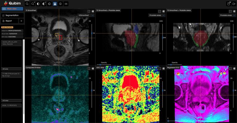 Combination of Philips’ leading AI-enabled MR imaging and Quibim’s AI-enabled image analysis software enables clinicians to deliver faster, easier prostate cancer care, to help mitigate staff shortages and lower the cost of care 