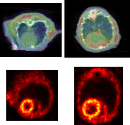PET Imaging Shows Protein Clumping May Contribute to Heart Failure Development