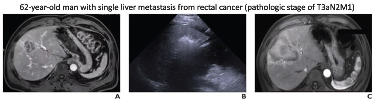 Metastasis was treated by upfront microwave ablation (MWA) and adjuvant systemic therapy (six cycles of FOLFIRI plus Bevacizumab). A. Axial contrast-enhanced T1-weighted MR image obtained before treatment shows 32x29x37-mm target lesion in segment V (arrow). B. Ultrasound image obtained during ultrasound-guided MWA shows hyperechogenicity around target lesion, corresponding with heat energy from ablation antennas. C. Axial contrast-enhanced T1-weighted MR image obtained 1 month after MWA shows 56x49x52-mm r