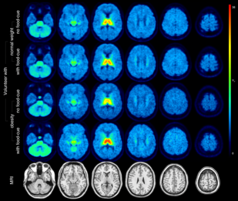 Molecular imaging with 18F-flubatine PET/MRI has shown that neuroreceptors in the brains of individuals with obesity respond differently to food cues than those in normal-weight individuals, making the neuroreceptors a prime target for obesity treatments and therapy