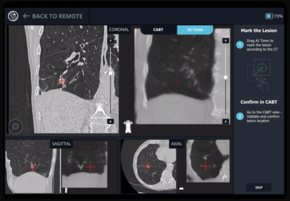 Body Vision Medical announced the successful validation of Body Vision's LungVision system with Fujifilm Healthcare Americas Corporation's Persona line of C-arms and FDR Cross two-in-one fluoroscopy C-arm and portable digital radiography solution