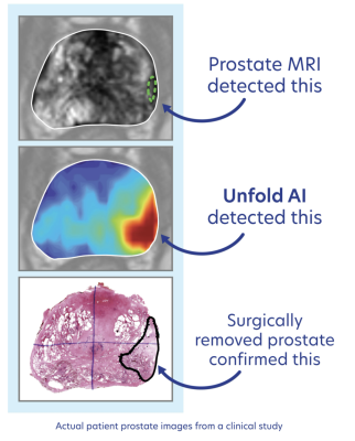 For the first time in a commercial setting, physicians are able to see the extent of disease and provide more personalized and precise treatments for prostate cancer patients using AI