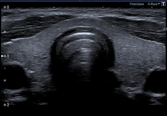 thyroid, Photonics PPP, ultrasound, LUCA probe, Europe