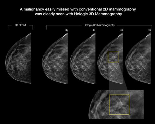 VuComp, M-Vu CAD, structured reporting, SR, digital breast tomosynthesis