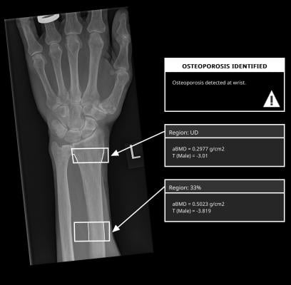 A groundbreaking solution for osteoporosis screening has been announced by medical X-ray technology pioneer IBEX Innovations Ltd. 