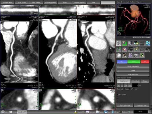 coronary CT angiography, CCTA, CAD, coronary artery disease, alcohol consumption, RSNA 2016
