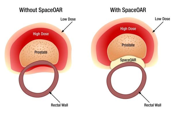 SpaceOAR System, Augmenix, hydrogel, prostate, rectum, cancer, radiotherapy