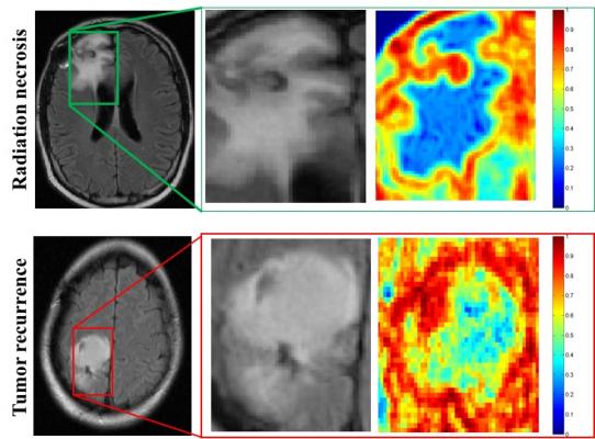 Case Western Reserve University study, machine learning, MRI, brain cancer diagnoses, radiomics