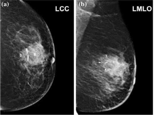 BioZorb three-dimensional implant, breast cancer, radiation therapy targeting, World Journal of Surgery article, ASTRO 2016 study