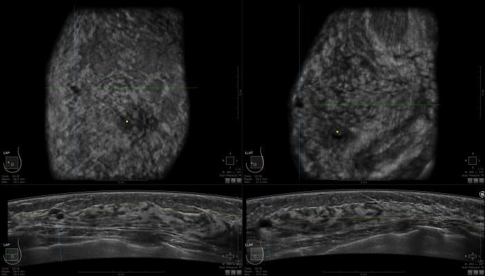KLAS, women's imaging, 3-D tomosynthesis, breast imaging