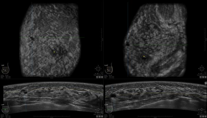 DCIS, ductal carcinoma in situ, mammography detection rates, Germany, Radiology journal