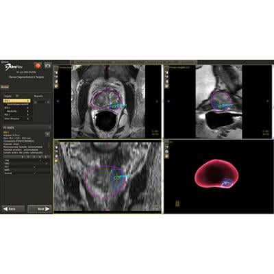 Synergy Radiology Associates Employs UroNav Fusion Biopsy System for Better Prostate Cancer Diagnosis