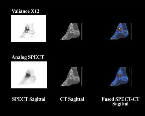 Valiance X12, SPECT/CT, CZT detectors, clinical trial